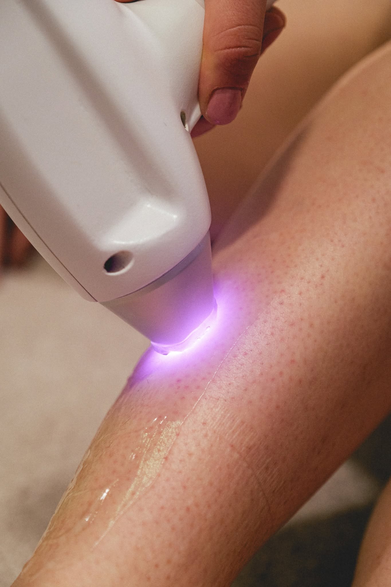 Trattamento laser sulla gamba con follicolite visibile