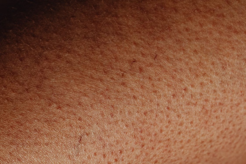 Dettaglio di pelle con rossori e imperfezioni dopo la depilazione